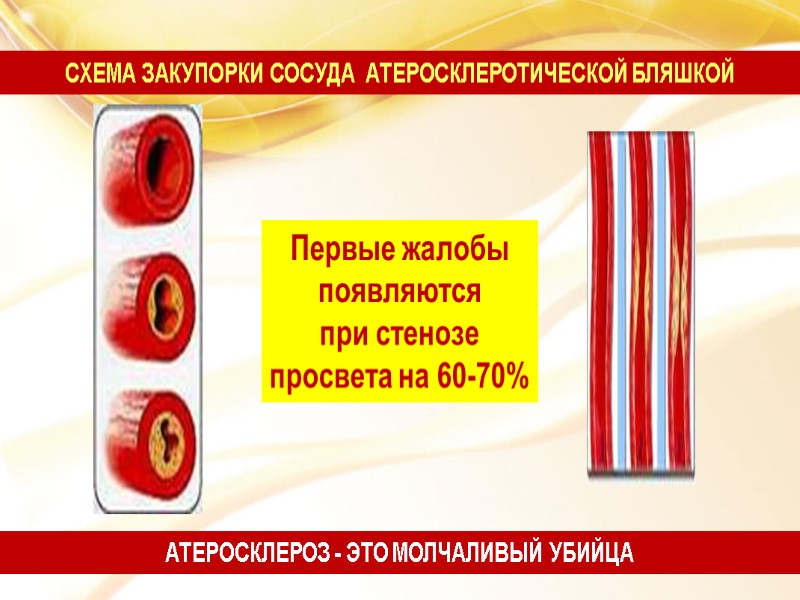 Первые жалобы  появляются  при стенозе  просвета на 60-70% СХЕМА ЗАКУПОРКИ СОСУДА